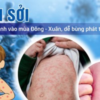 Thủ tướng yêu cầu tăng cường công tác phòng, chống bệnh sởi