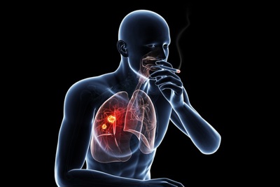  Cơ chế gây ung thư của khói thuốc lá 