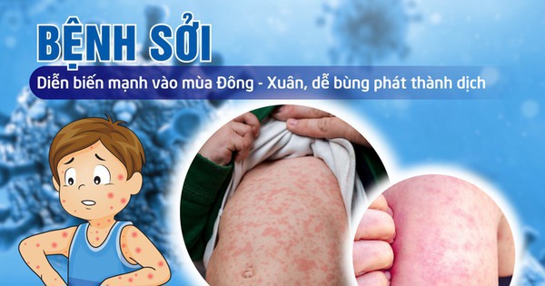 Bệnh sởi là bệnh truyền nhiễm lây lan qua đường hô hấp, đã từng xảy ra những đợt dịch lớn; hiện chưa có thuốc điều trị đặc hiệu.