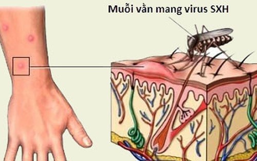  Muỗi mang virus sốt xuất huyết sẽ truyền bệnh gián tiếp từ người này sang người khác. Nguồn: internet